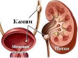 Уролитиаз схема болезни